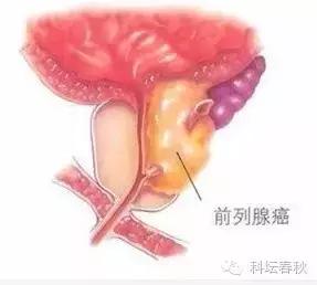 前列腺癌超强科普贴，耐受性前列腺癌治疗已经出现曙光
